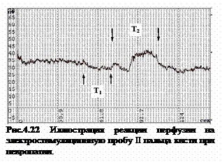 Подпись:  
Рис.4.22 Иллюстрация реакции перфузии на электростимуляционную пробу II пальца кисти при невропатии.
