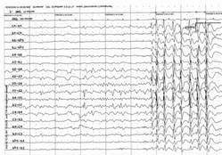 http://epileptologist.ru/img/article/92/6.jpg