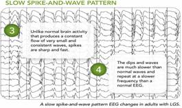 https://www.onfi.com/content/dam/onfi/images/What%20is%20LGS/eeg-spike-and-wave.jpg